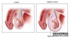 腹腔镜微创术 轻松解决鞘膜积液